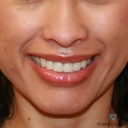 After veneers